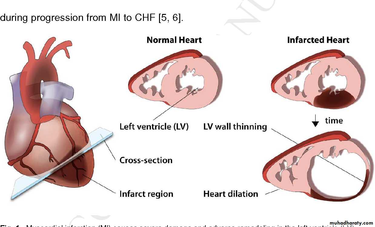 STEMI
