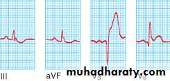STEMI