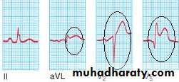 STEMI