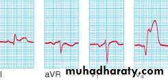 STEMI