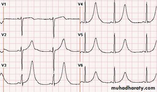 STEMI