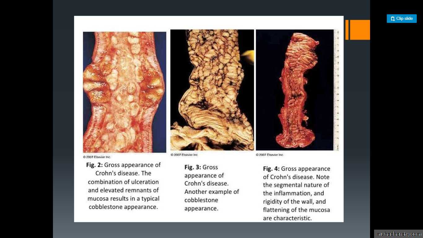 Small and Large Intestines