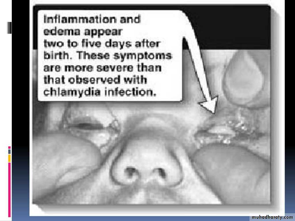Streptococcus pneumonia