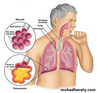 Streptococcus pneumonia