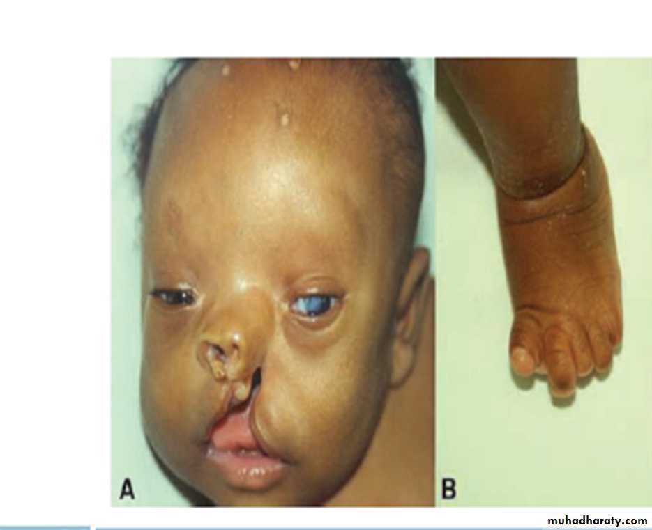 Birth defects
