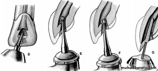 Endodontic instruments