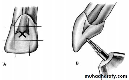 Endodontic instruments
