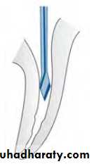 Endodontic instruments