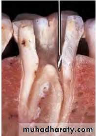 Endodontic instruments