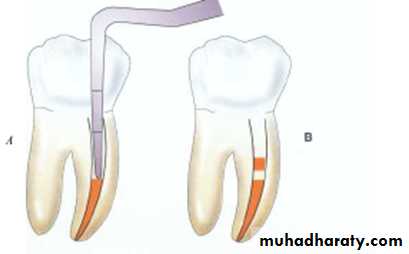 Endodontic instruments
