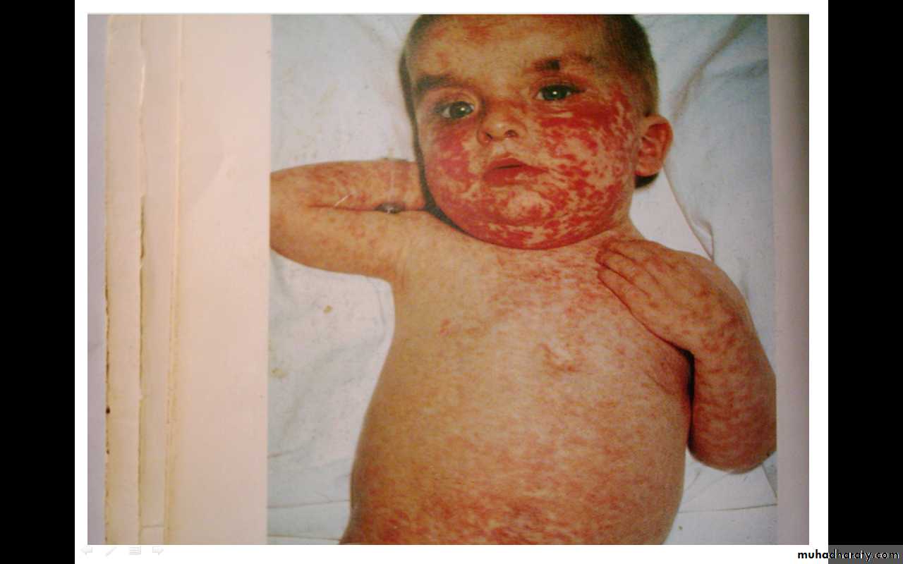 Measles