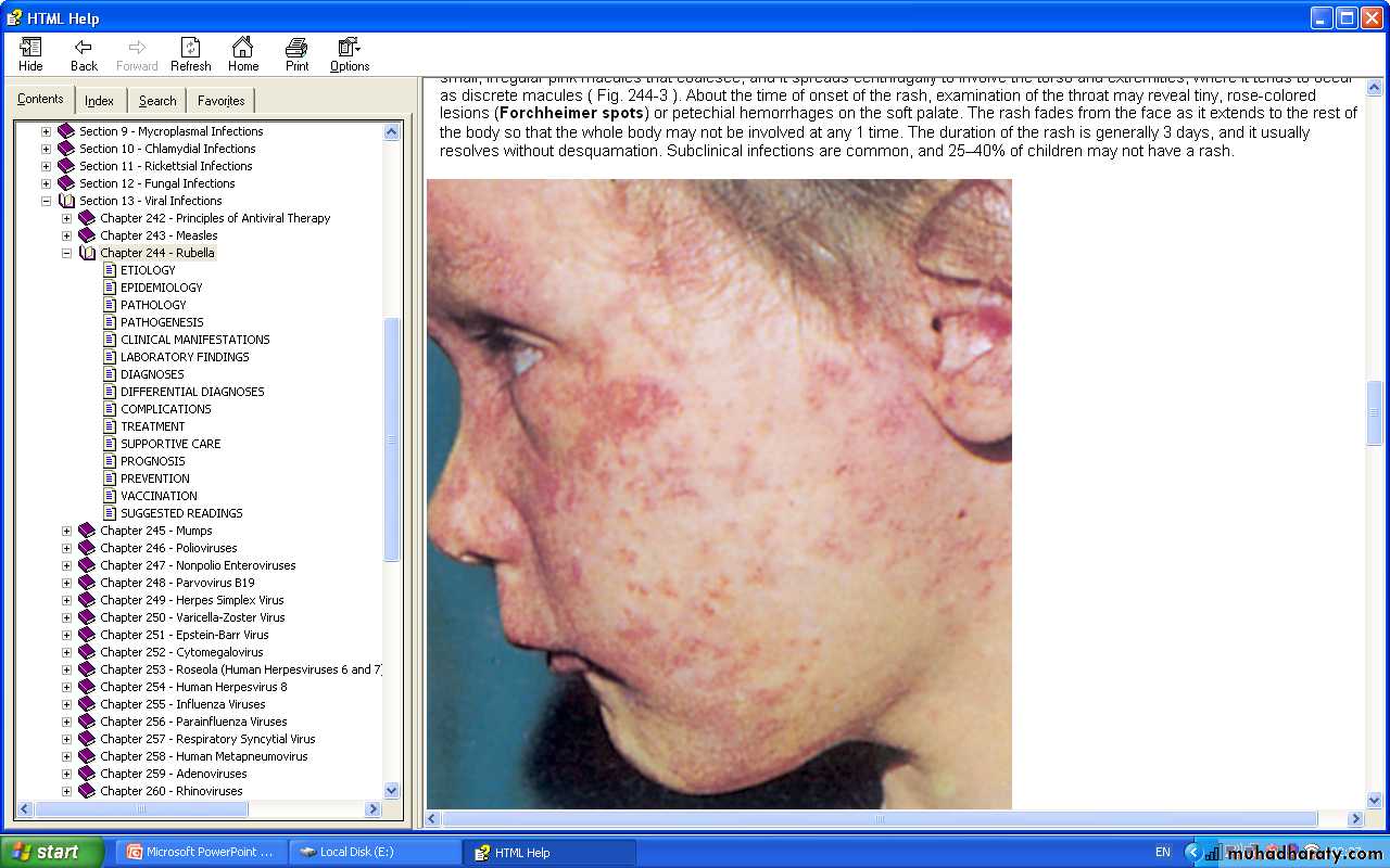 Measles