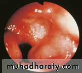Peptic ulcer