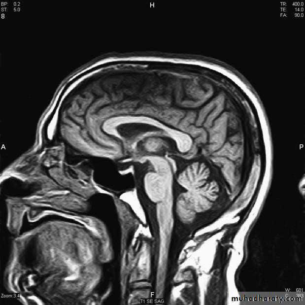 Brain imaging