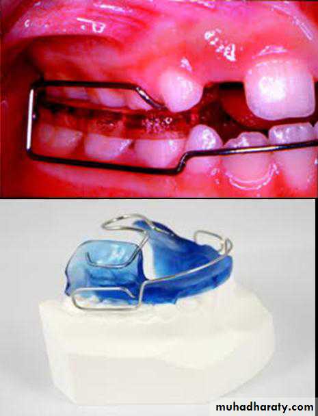 Myofunctional appliances