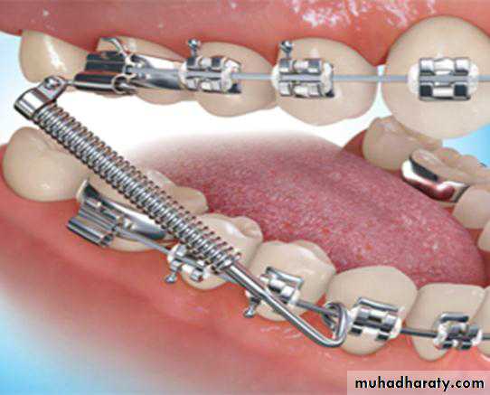 Myofunctional appliances