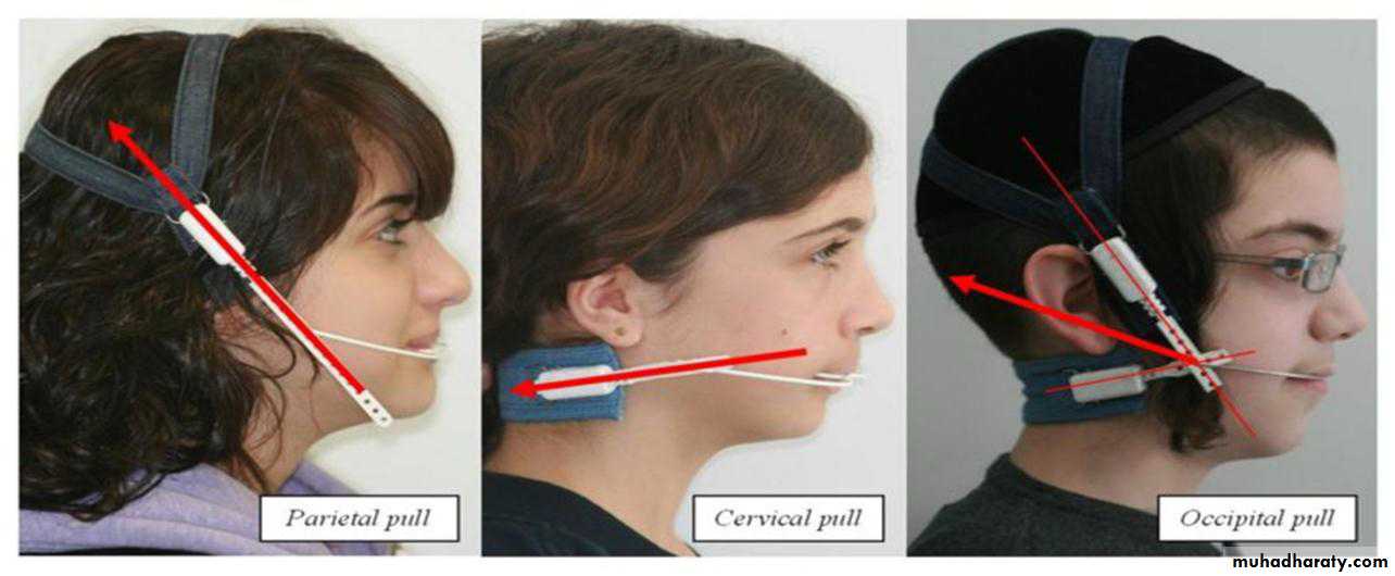 Myofunctional appliances