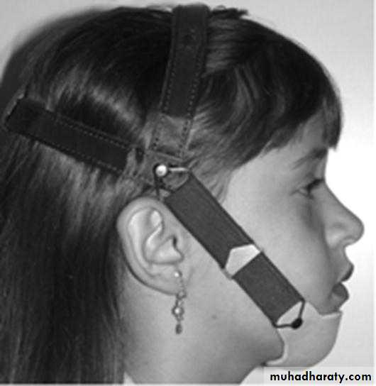 Myofunctional appliances