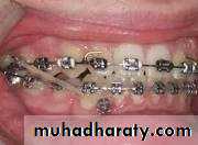 Extra oral appliances