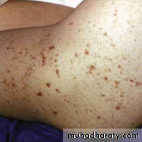 CNS Infections