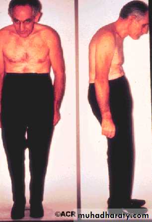 Seronegative Arthritis