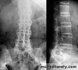Seronegative Arthritis