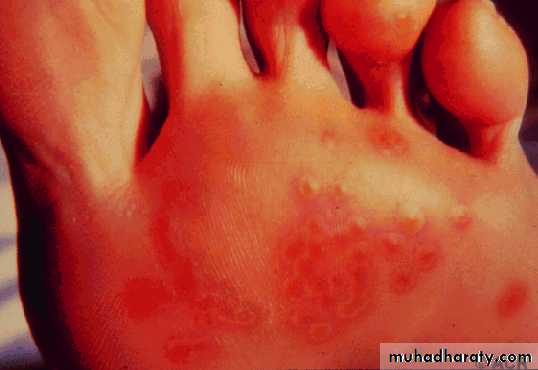 Seronegative Arthritis