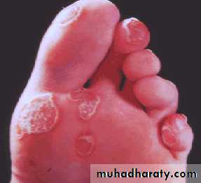 Seronegative Arthritis