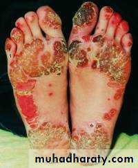 Seronegative Arthritis