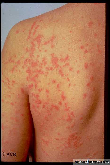 Vasculitis