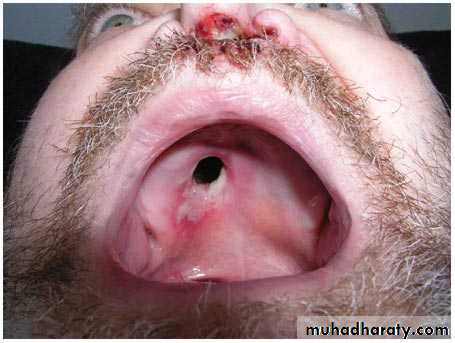 Vasculitis