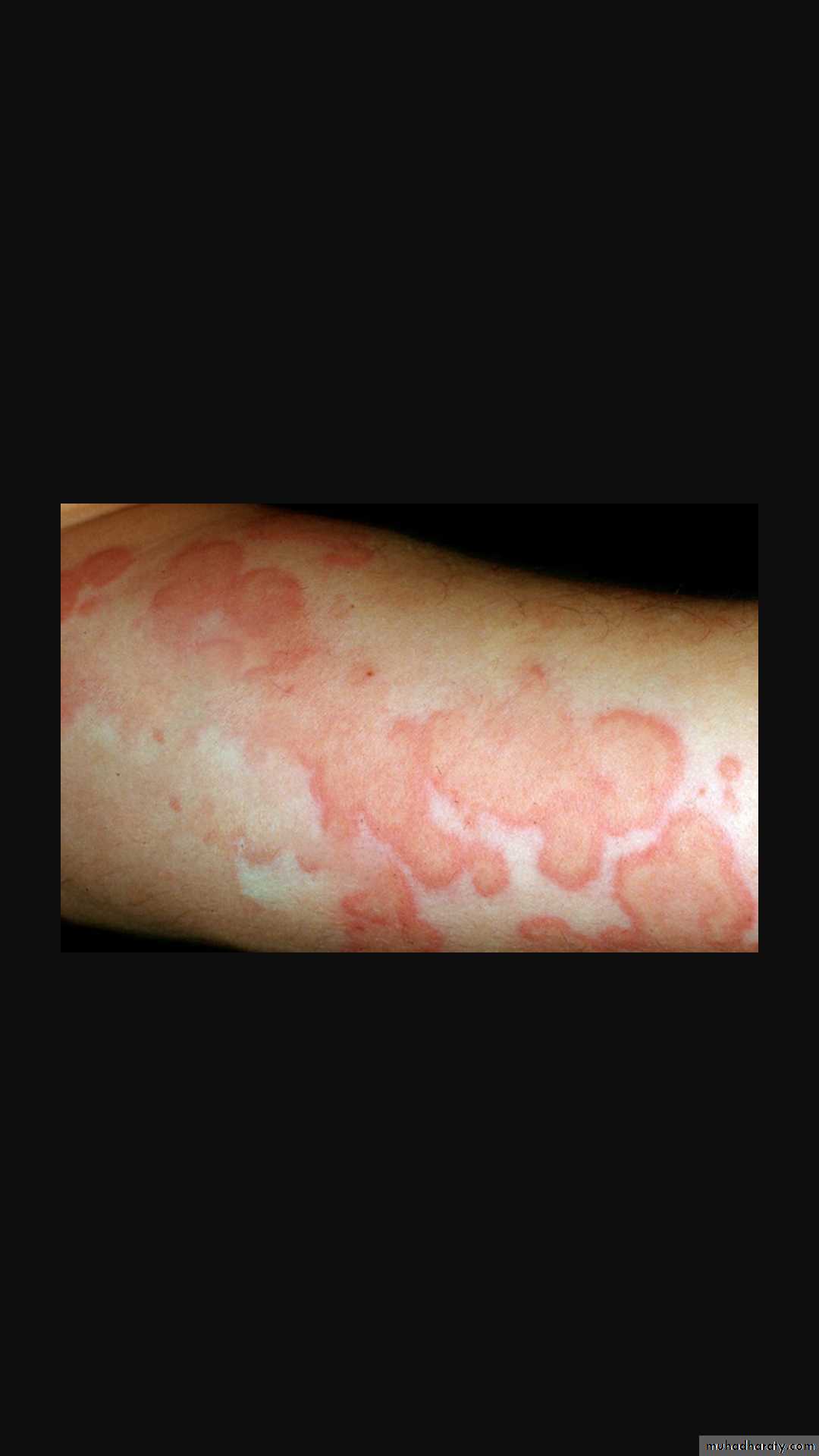 Vasculitis