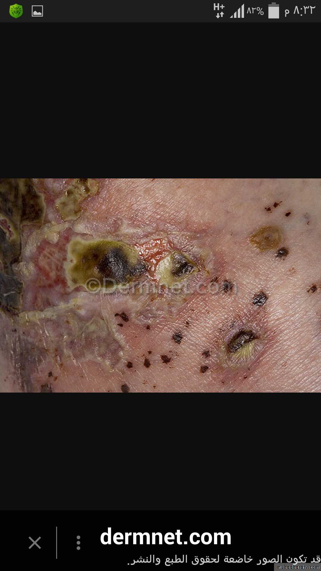 Vasculitis