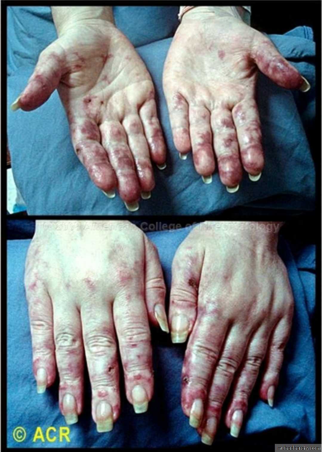 Vasculitis
