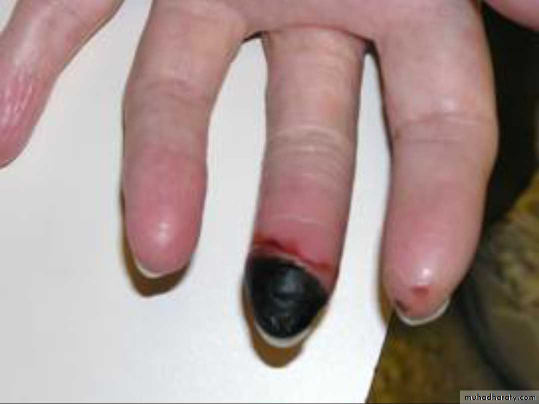 Vasculitis