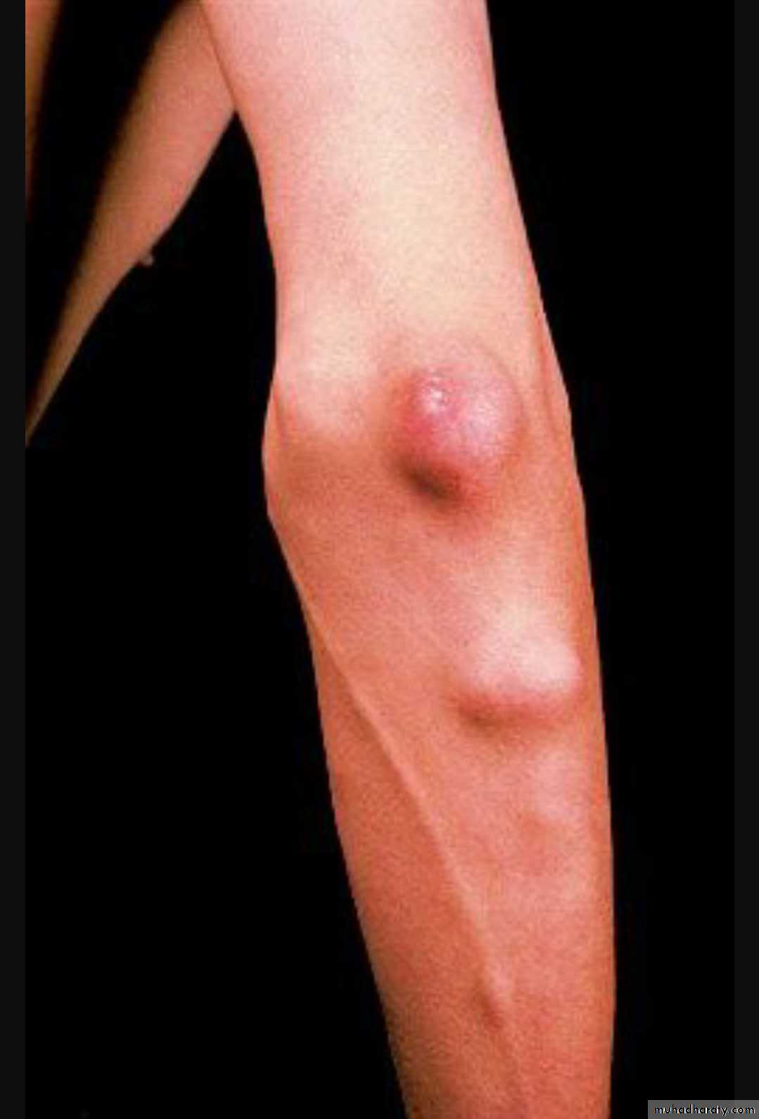 Vasculitis