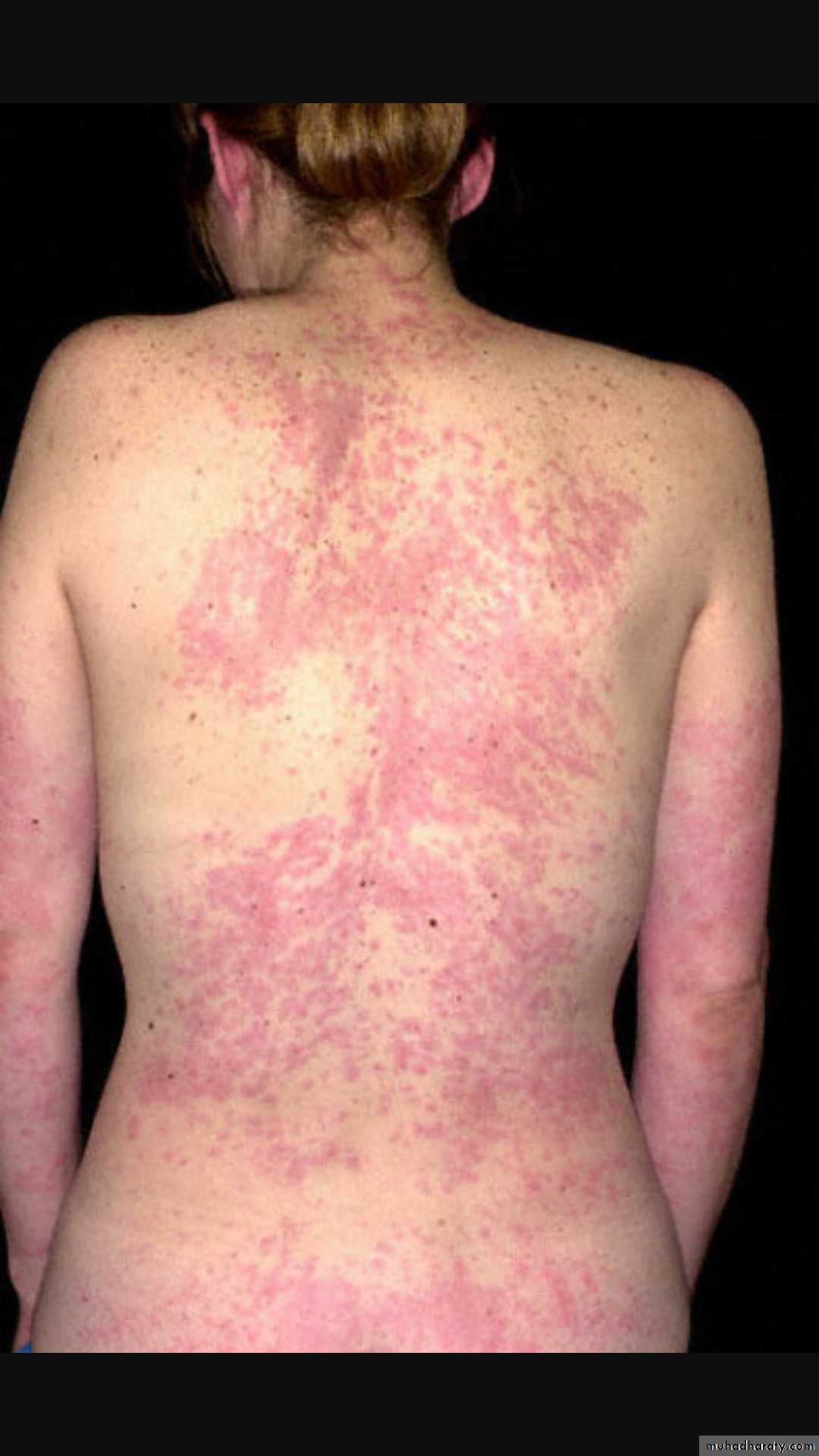 Vasculitis
