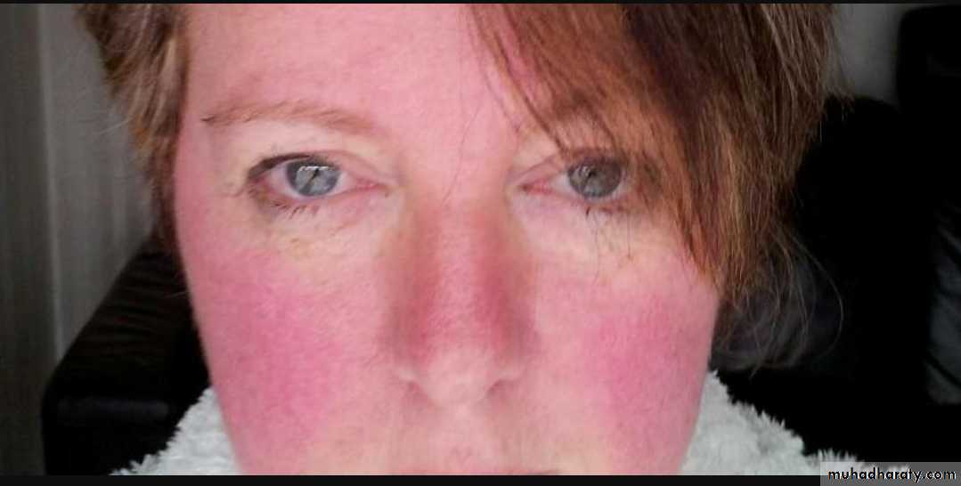 Vasculitis