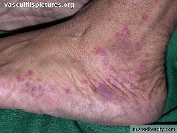 Vasculitis
