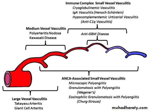 Vasculitis