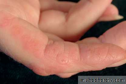 Antiphospholipid Syndrome