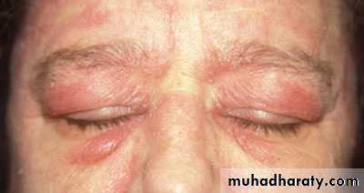 Antiphospholipid Syndrome