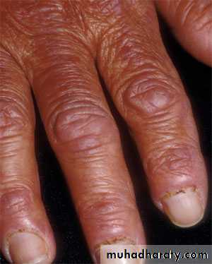 Antiphospholipid Syndrome