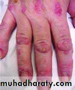 Antiphospholipid Syndrome