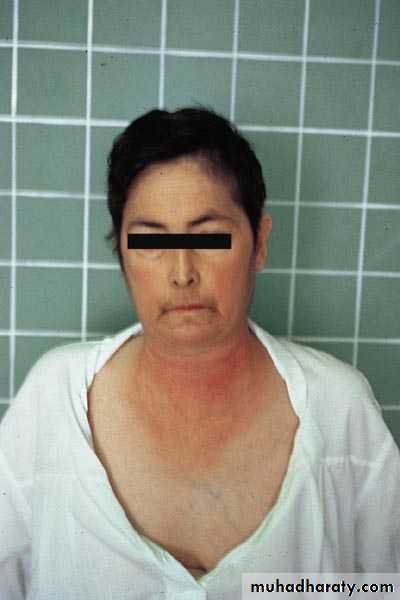Antiphospholipid Syndrome