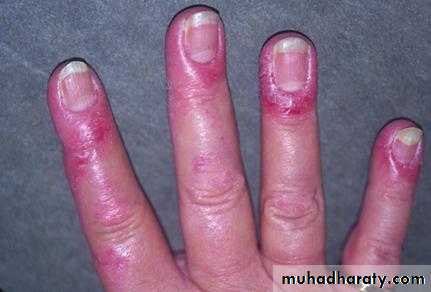 Antiphospholipid Syndrome