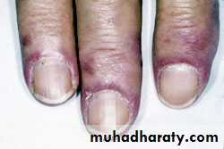 Antiphospholipid Syndrome