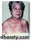 Antiphospholipid Syndrome