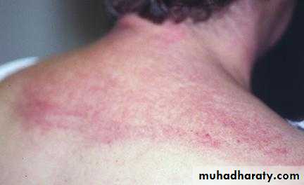 Antiphospholipid Syndrome