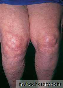 Antiphospholipid Syndrome